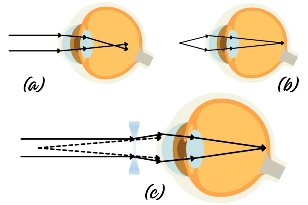 08 - Ray Diagram Illustrating Short-Sightedness (Myopia)