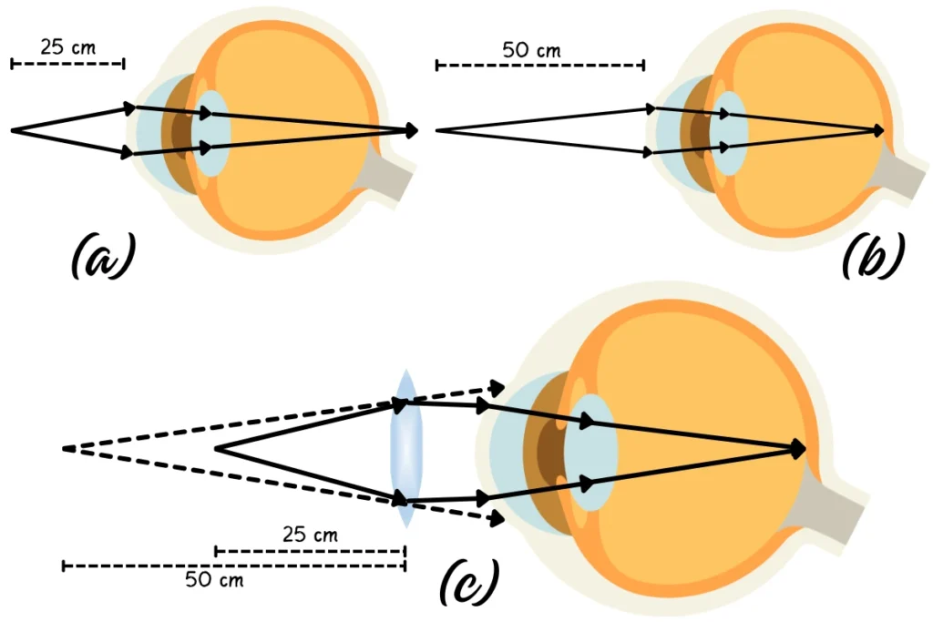 10 - Ray Diagram Illustrating Long-Sightedness (Hyperopia)
